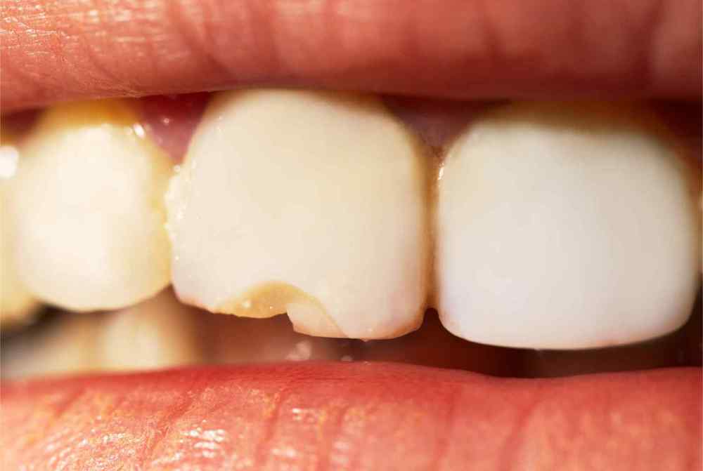 Broken-Chipped-Tooth.jpg