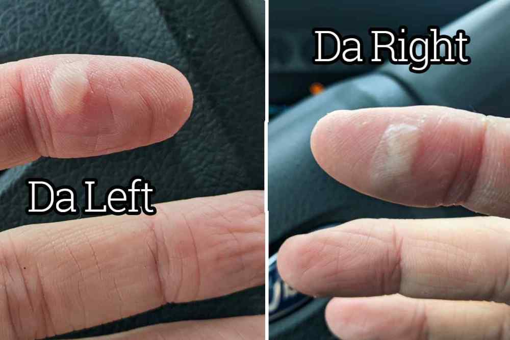 pic-2-blisters.jpg