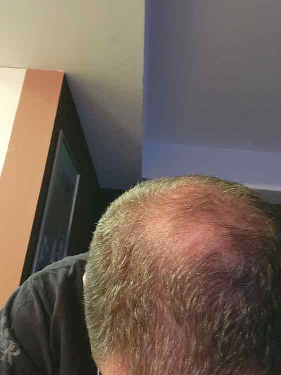 bald.jpg.11bc3d994d5386402918ad82c30bc169.jpg